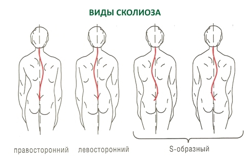 Сколиоз